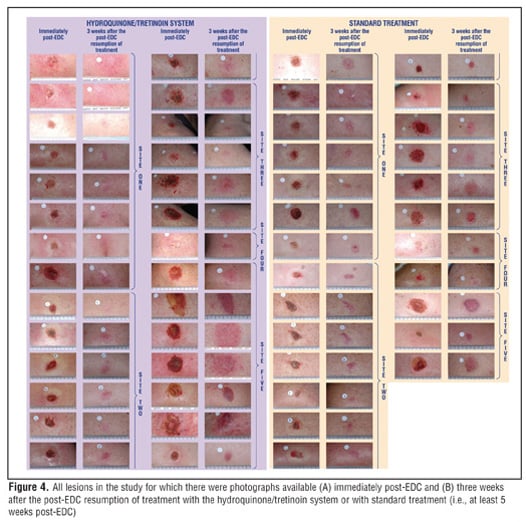 Hydroquinone Cream 12% - Product Image