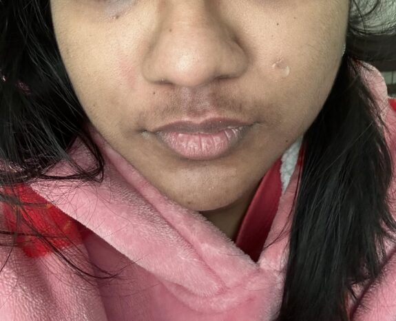 Hydroquinone lip treatment product.