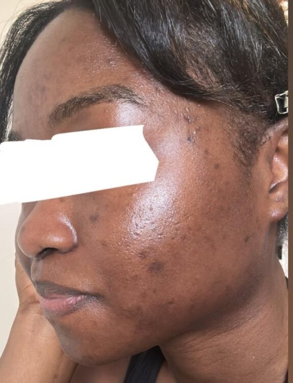 Hydroquinone 4% skin lightening cream.