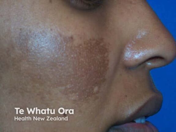 Hydroquinone skin whitening treatment cream.