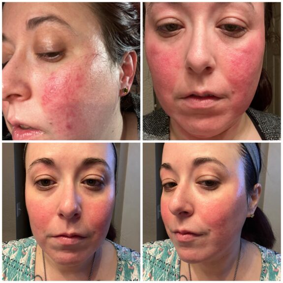 Metronidazole and Tretinoin Gel. Acne treatment.