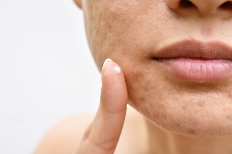 Azelaic Acid Bleaching Cream